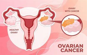 Image result for Ovarian Cancer