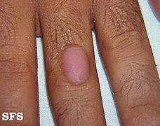 Image result for Red Bumps On Knuckles