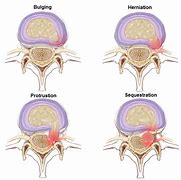 Image result for Disc Herniation Types