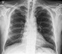 Image result for Lung Nodules On Chest X-Ray