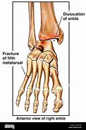 Image result for Broken and Dislocated Ankle