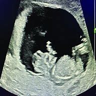 Image result for Fetal Anencephaly