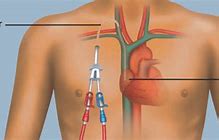 Image result for Dialysis Cath