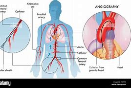 Image result for Angiogram Pictures