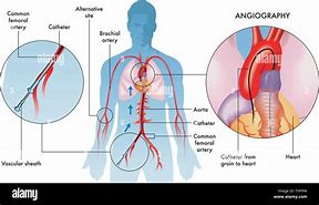 Image result for Angiogram Labeled