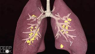 Image result for Viral Respiratory Infection