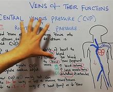 Image result for Elevated Central Venous Pressure