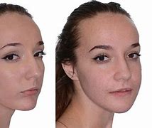 Image result for Asymmetrical Jaw
