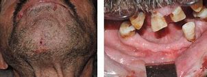 Image result for Pilonidal Cyst with Teeth and Hair
