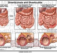 Image result for Diverticulitis vs Diverticulosis Chart