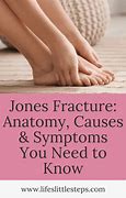 Image result for Jones Fracture