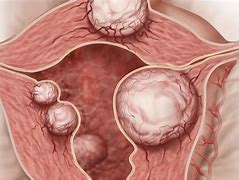 Image result for fibroids tumors