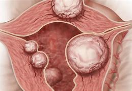 Image result for Fibroid Types Uterus