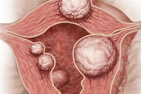 Image result for Fibroid Tissue