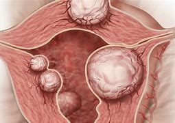 Image result for 2 Cm Fibroid in Uterus