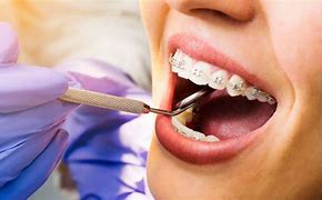 Image result for Brace Teeth Dentist