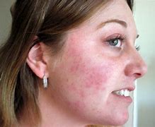 Image result for Allergic Reaction On Face and Neck