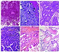 Image result for Epithelial Ovarian Tumors