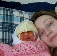Image result for Babies with Anencephaly