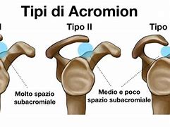 Image result for acromonia