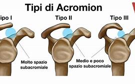 Image result for acrominaci�n