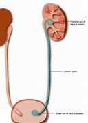 Image result for Kidney Stone Stent Removal