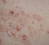 Image result for Extensive Molluscum Contagiosum