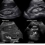 Image result for What Is Anechoic On Ultrasound