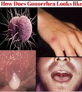 Image result for Gonorrhea Sores