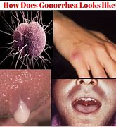 Image result for Gonorrhea On Skin