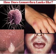 Image result for STD Infected