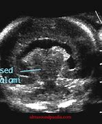 Image result for Holoprosencephaly vs Hydrocephalus Ultrasound