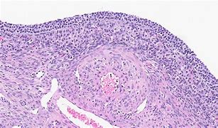 Image result for Ovarian Cyst Pathology