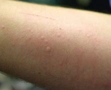 Image result for Tree Nut Allergy