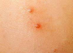 Image result for Molluscum vs Warts