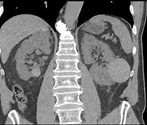 Image result for Large Renal Cyst CT Scan