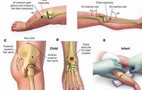 Image result for Io Medical