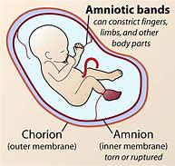 Image result for amnios