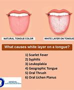 Image result for Gonorrhea On Tongue