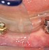 Image result for Magnet Dental Attachment