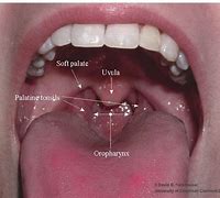 Image result for Papilloma On Tonsil