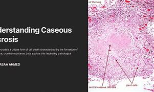Image result for Caseous Necrosis