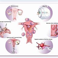 Image result for Uterine Fibroid Classification