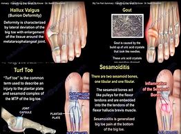 Image result for Sharp Pain in Big Toe