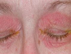 Image result for Skin Rashes around Eyes