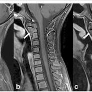 Image result for Cervical Spine MRI with Contrast