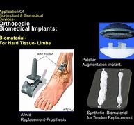 Image result for Different Bioimplants in Ancient Age
