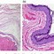 Image result for Skin Inclusion Cyst