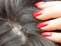 Image result for Eczema in Hair