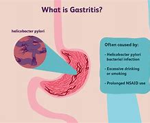 Image result for gastritis